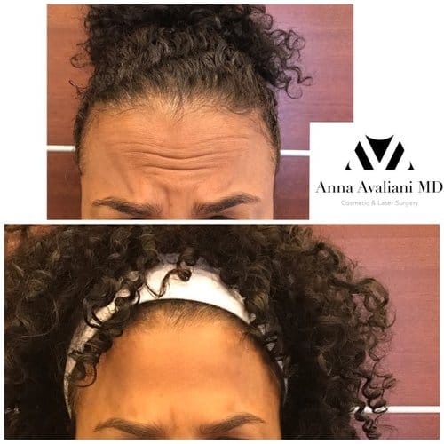 Botox before and after, result 74