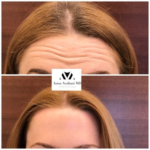 Botox before and after, result 75