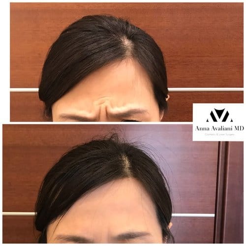 Botox before and after, result 76