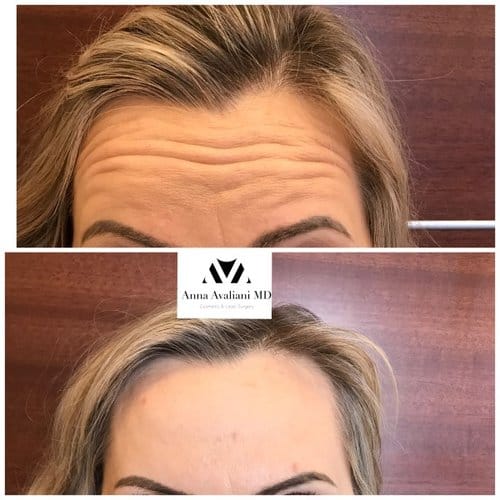 Botox before and after, result 77