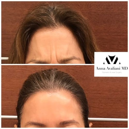 Botox before and after, result 78