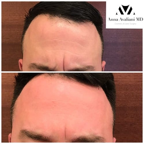 Botox before and after, result 79