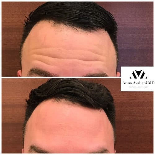 Botox before and after, result 81