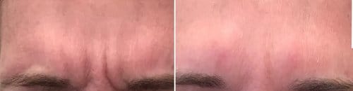 Botox before and after, result 84
