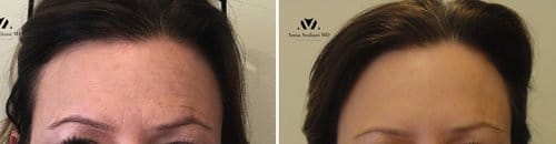 Botox before and after, result 98