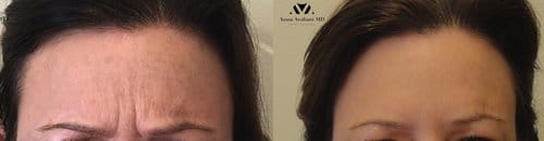 Botox before and after, result 99