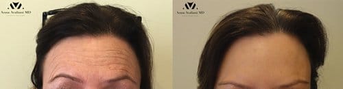 Botox before and after, result 100