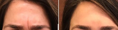 Botox before and after, result 85
