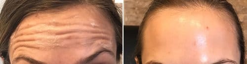Botox before and after, result 86