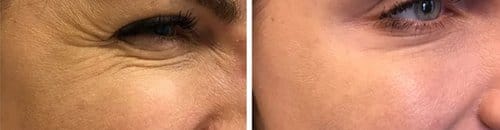 Botox before and after, result 87