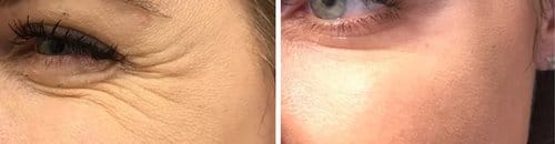 Botox before and after, result 88