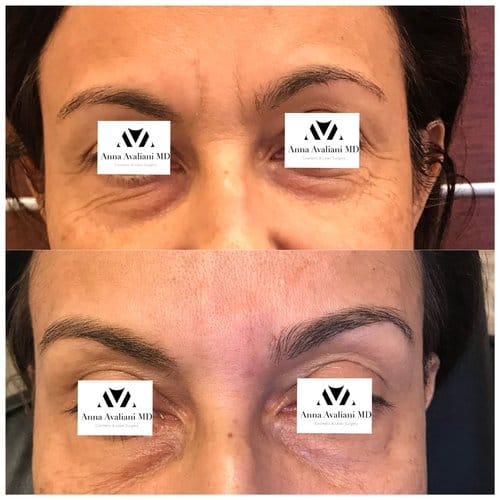 Botox before and after, result 31