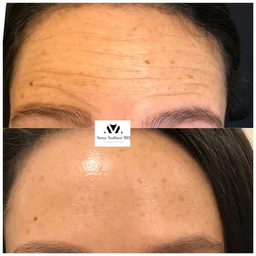 Botox before and after, result 40
