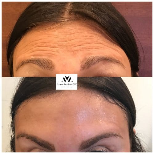 Botox before and after, result 41