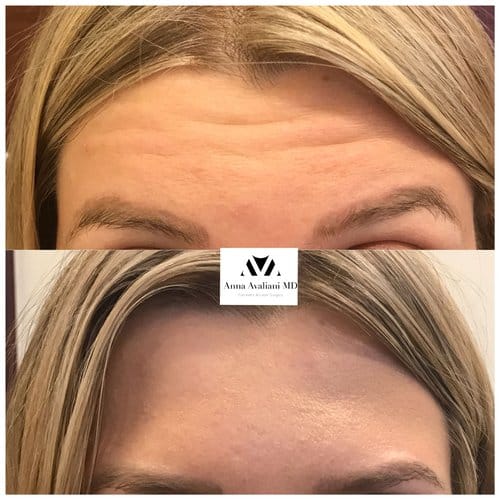 Botox before and after, result 42