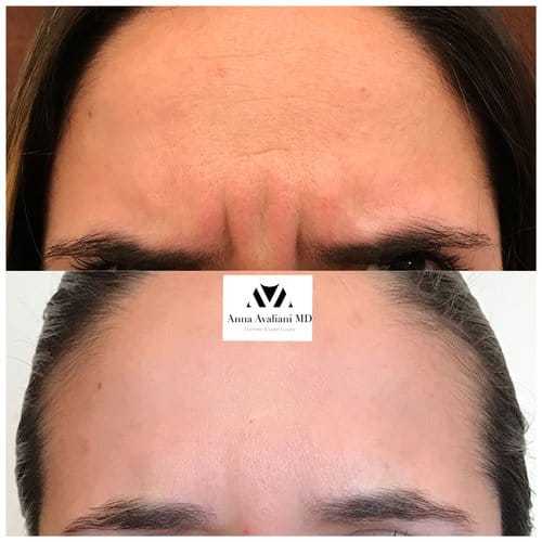 Botox before and after, result 43