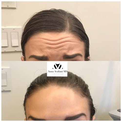Botox before and after, result 44