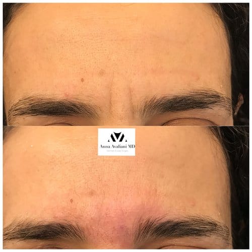 Botox before and after, result 45