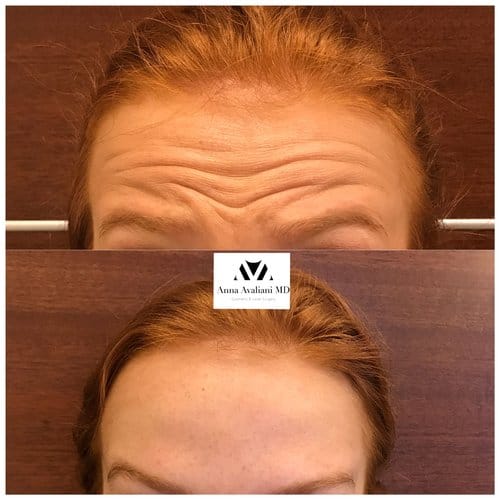 Botox before and after, result 46