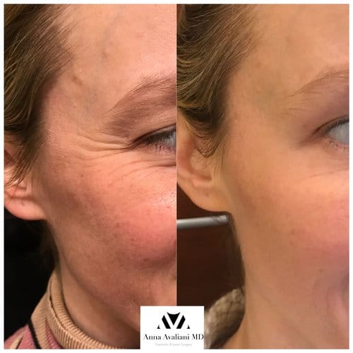 Botox before and after, result 47