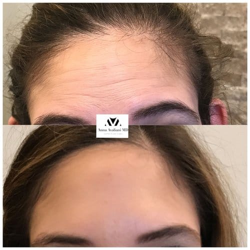 Botox before and after, result 48