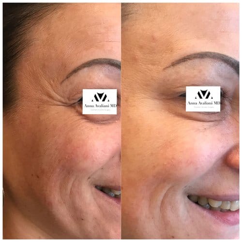 Botox before and after, result 32