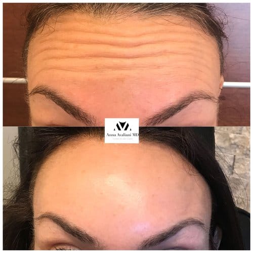 Botox before and after, result 33