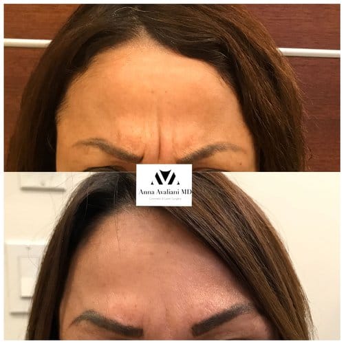 Botox before and after, result 34