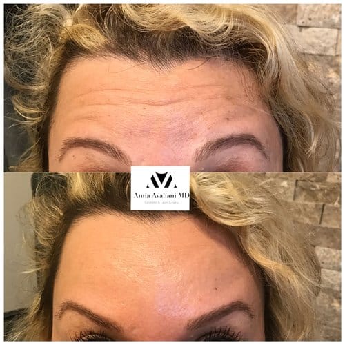 Botox before and after, result 35