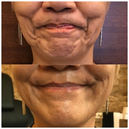 Botox before and after, result 36