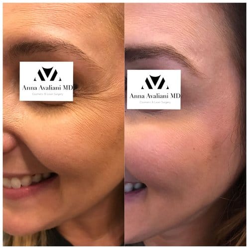Botox before and after, result 37