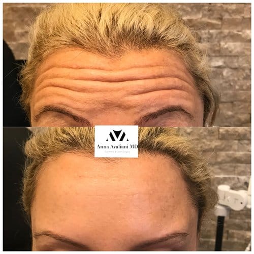 Botox before and after, result 38