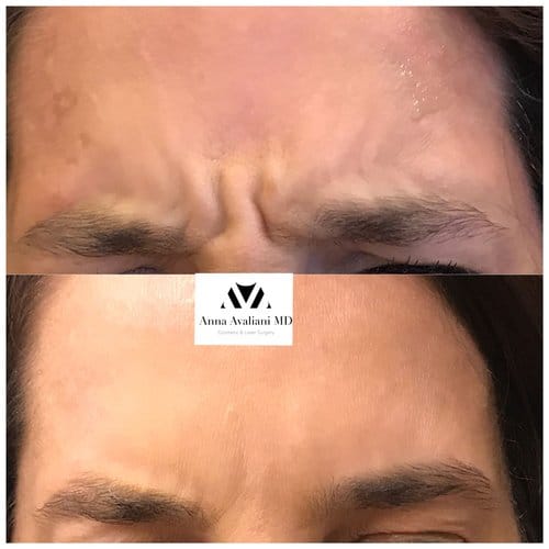 Botox before and after, result 39