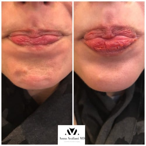 Botox before and after, result 49