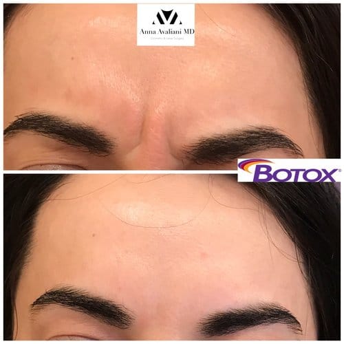 Botox before and after, result 58
