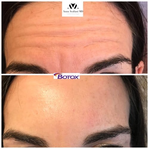 Botox before and after, result 59