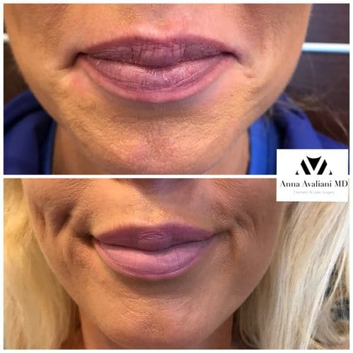 Botox before and after, result 60
