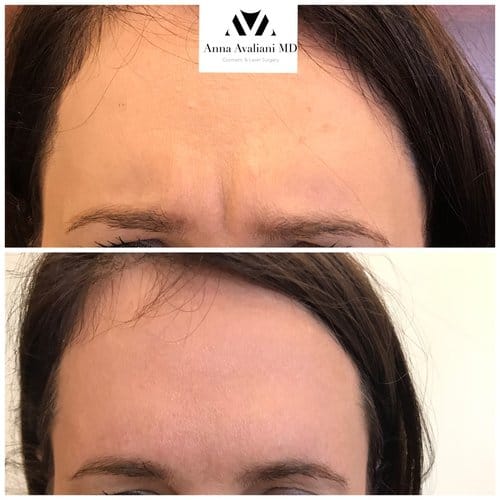 Botox before and after, result 61