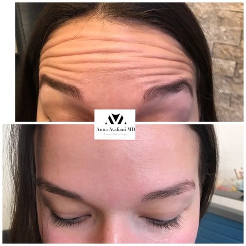 Botox before and after, result 62