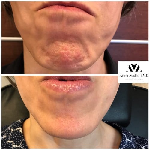 Botox before and after, result 63