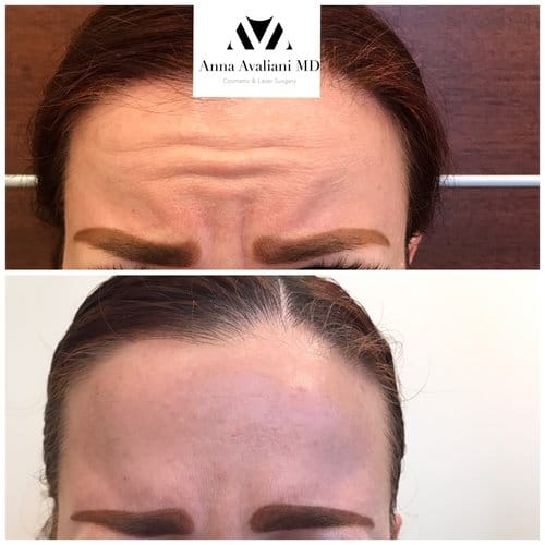 Botox before and after, result 64