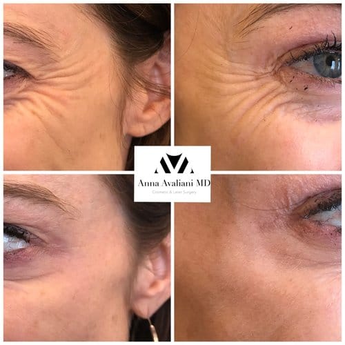 Botox before and after, result 65