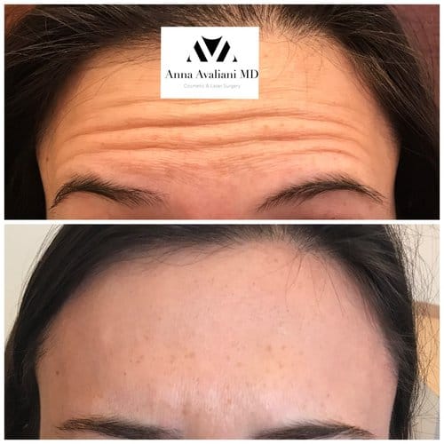 Botox before and after, result 66