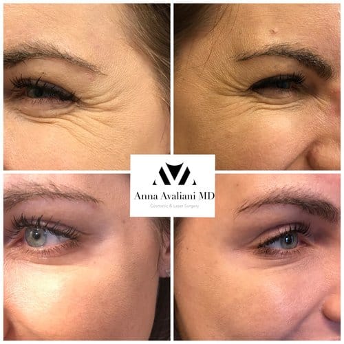 Botox before and after, result 67