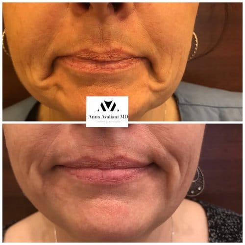 Botox before and after, result 50