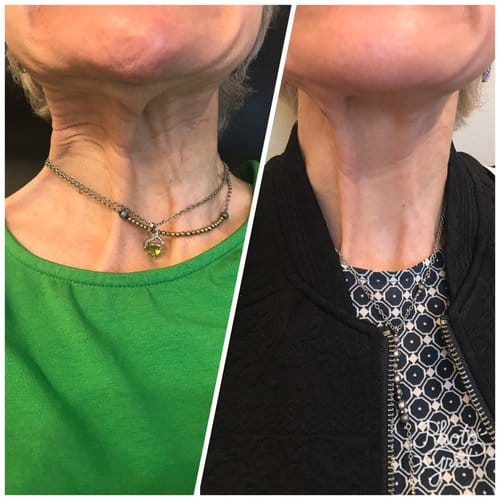 Botox before and after, result 68