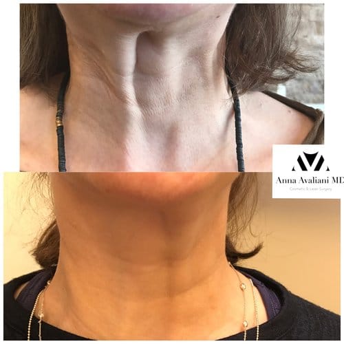 Botox before and after, result 69