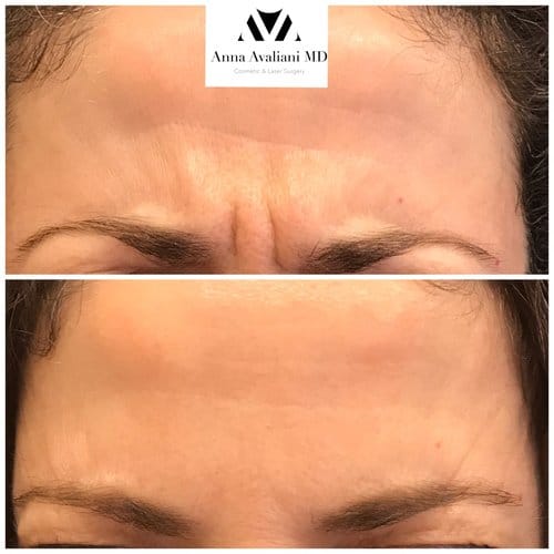 Botox before and after, result 51