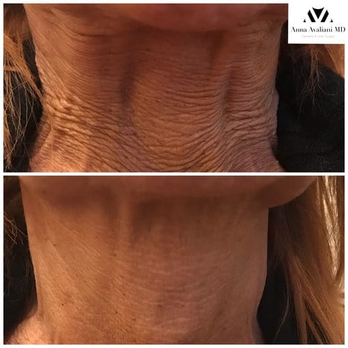 Botox before and after, result 52