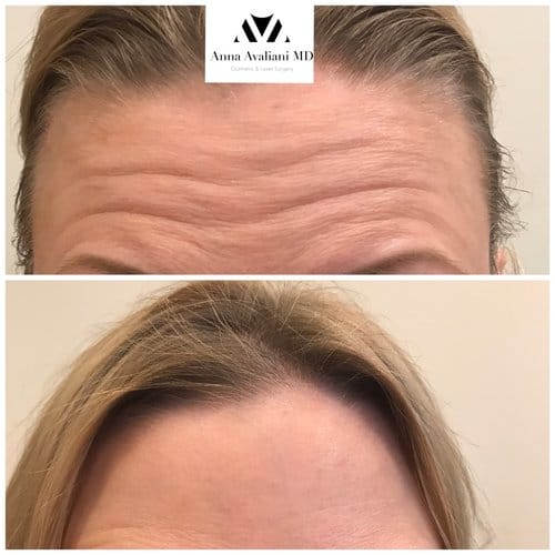 Botox before and after, result 53